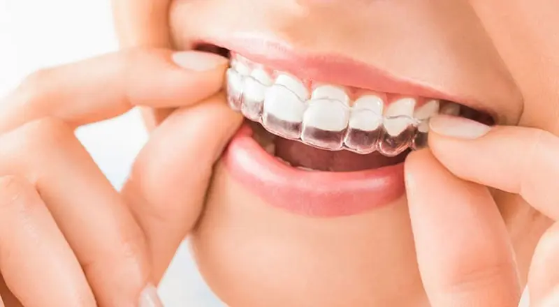 Invisalign Aligners